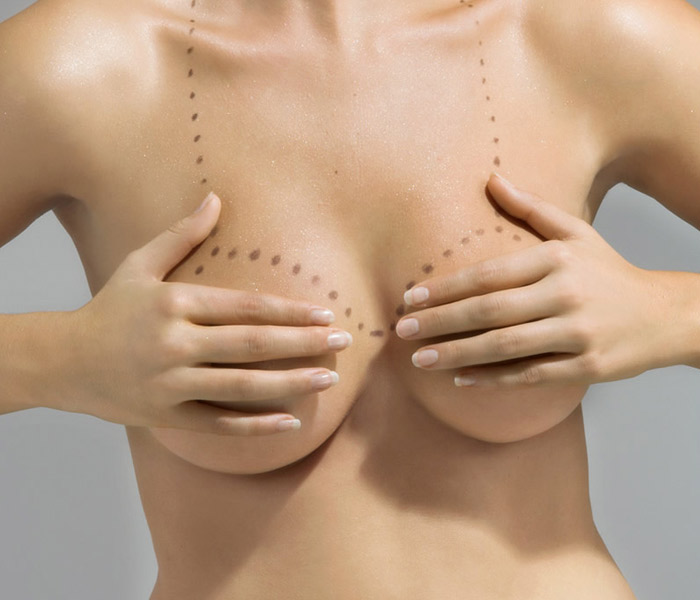 Mamoplastia de Aumento